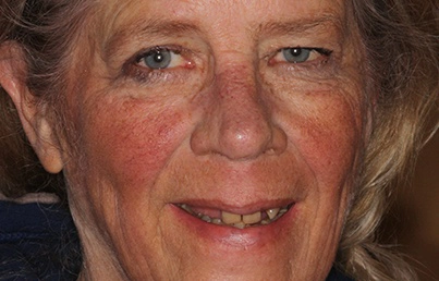 Smile gallary image - Before